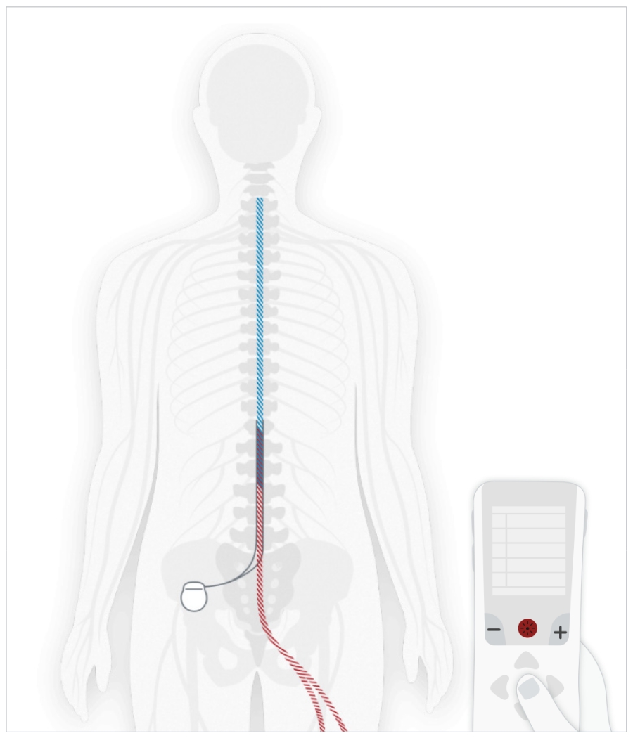 Funktionsweise der Rückenmarkstimulation
