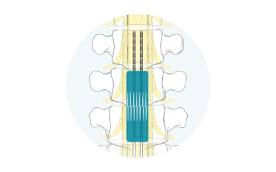 Contour SCS Therapie