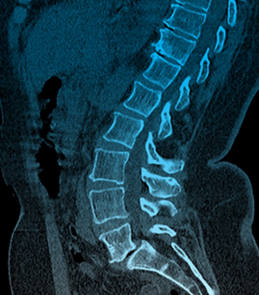 CT-Bild des unteren Rückens