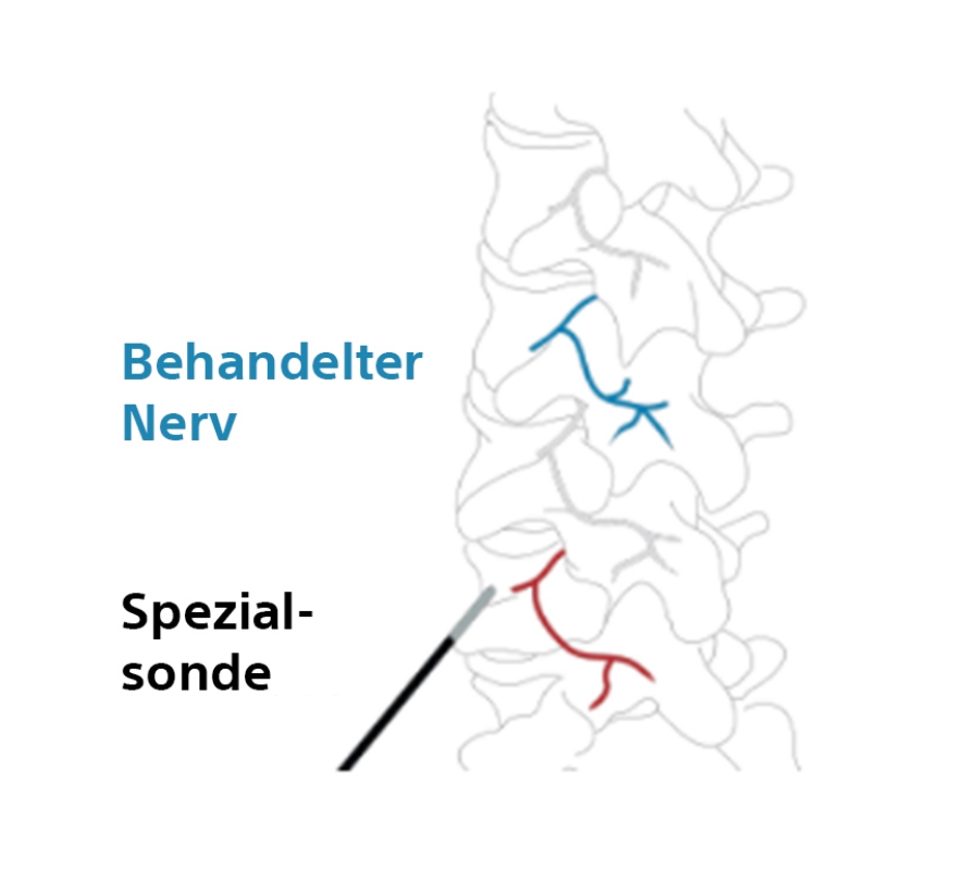 Wiederholte RFA-Behandlung bei mehreren Nerven